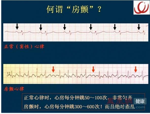 阵发性房颤的心室率控制 or 转复?