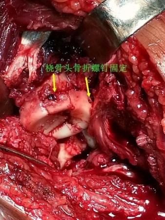 肘关节脱位桡骨头骨折