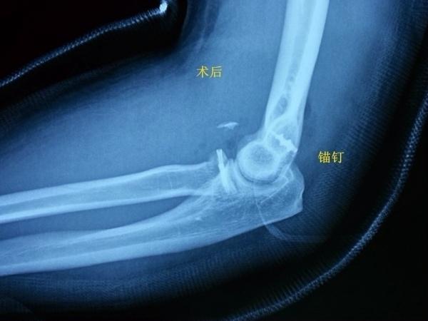 比恐怖三联症少了尺骨冠状突骨折,需要手术修复桡骨头和韧带复合体.