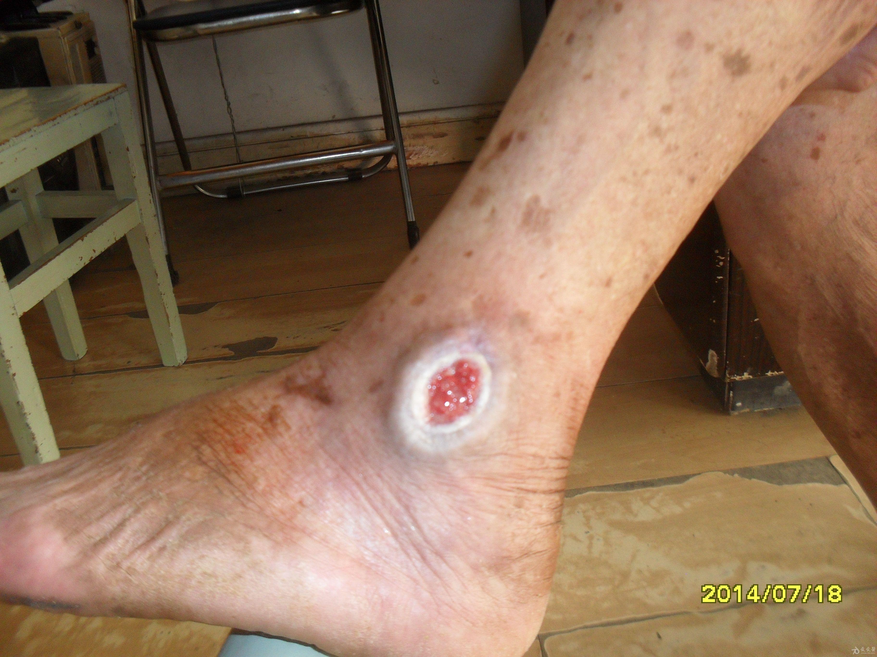 左脚外踝皮肤慢性溃疡近两年,迭经中西治疗,花费近两万元人民币,未见