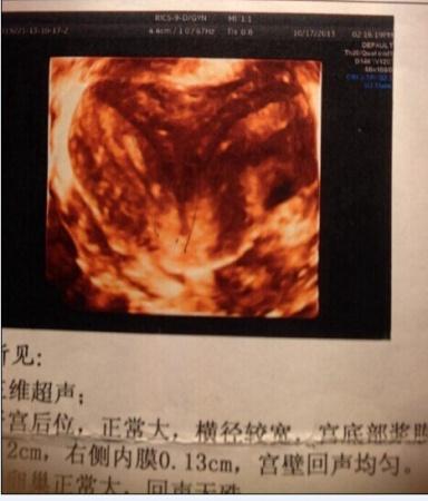 宫底凹形(月经感觉3-7做的)门诊医生按三维单子看说是纵膈子宫