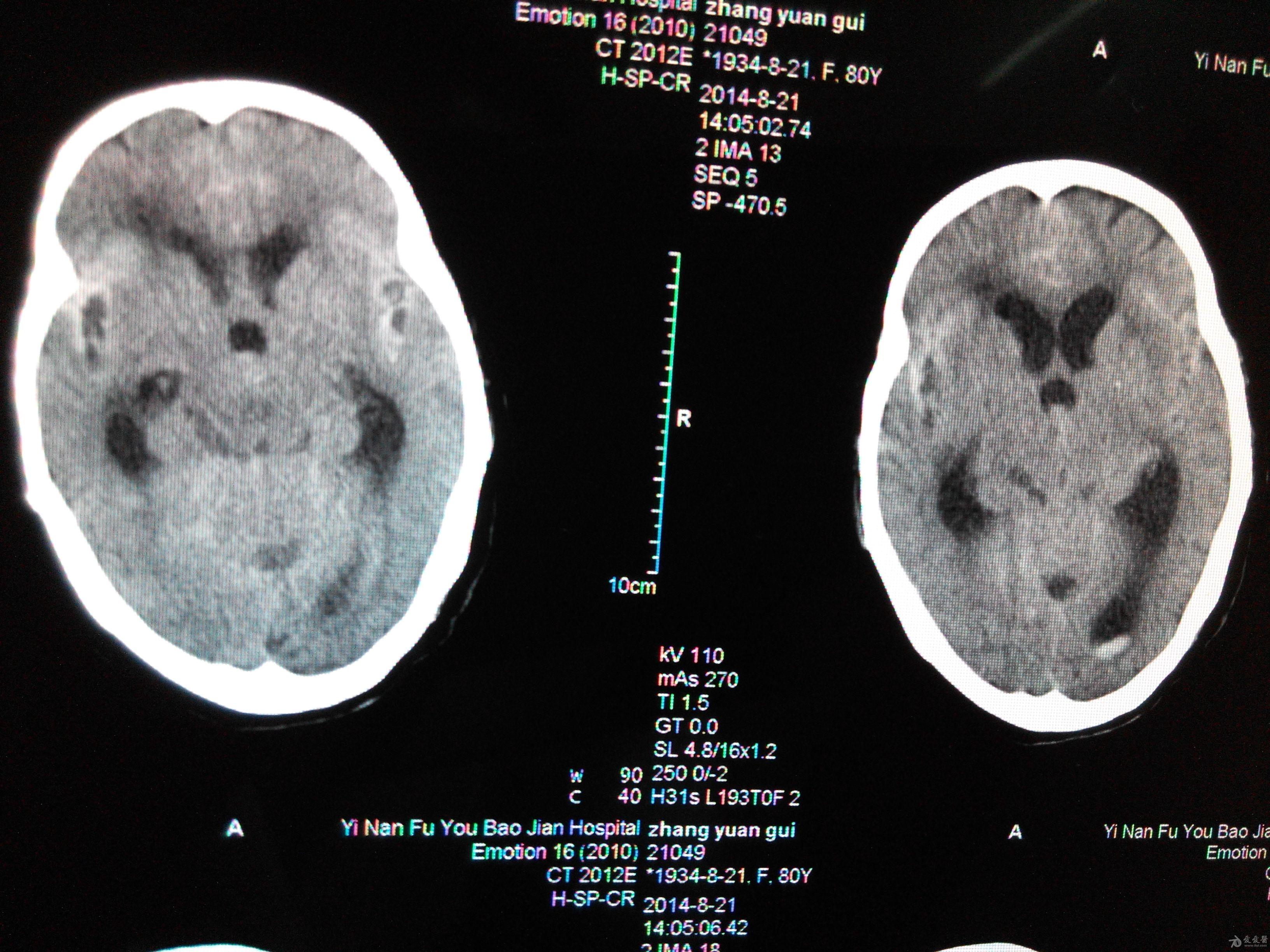 150/80mmhg,神志不清,昏睡状态,双瞳孔d=2mm,光反应迟钝,脑膜刺激征