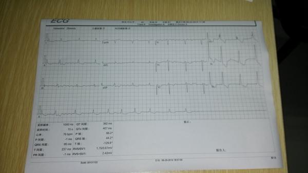 临床诊断心肌梗死的患者心电图