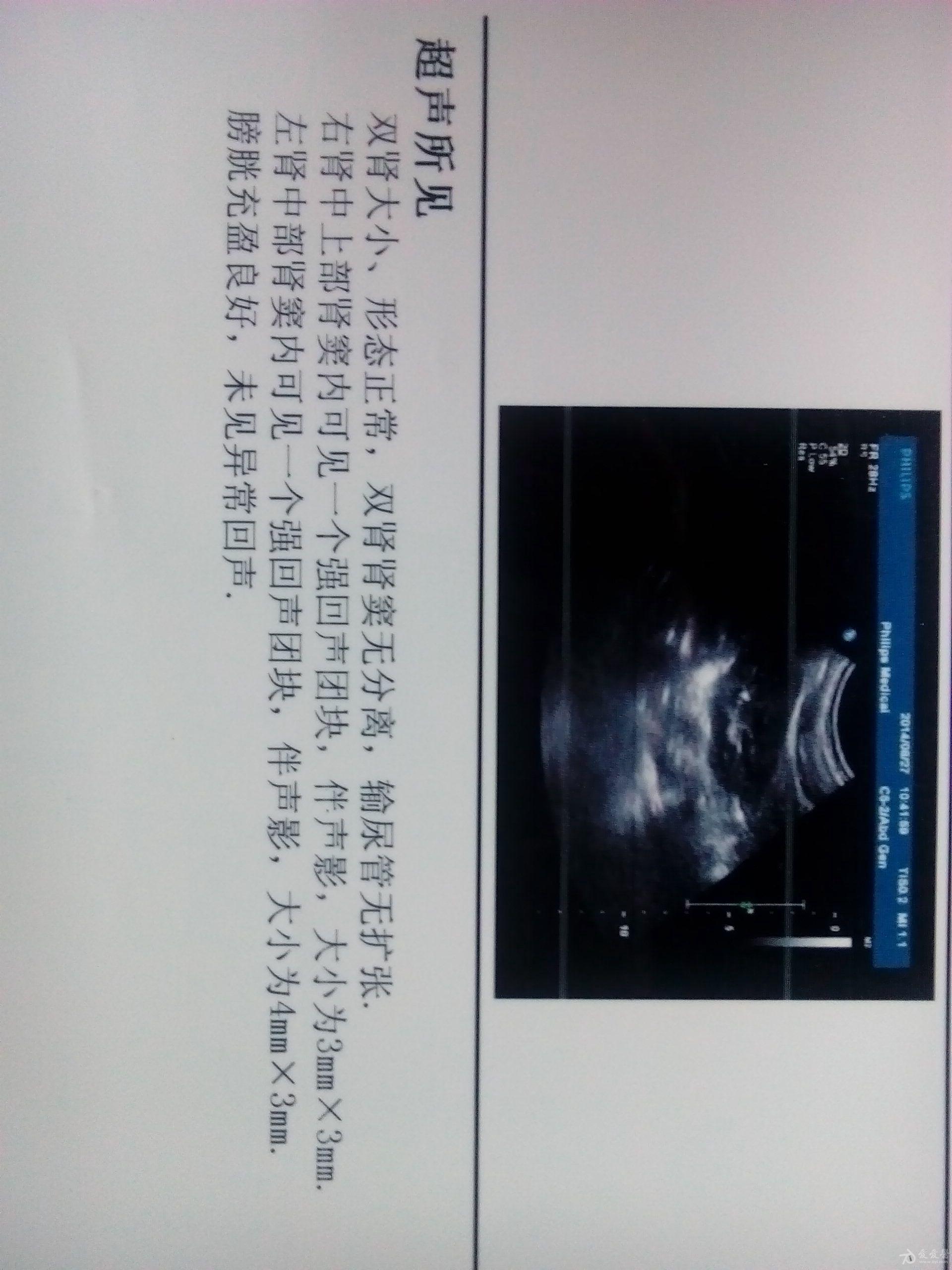 双肾窦结石
