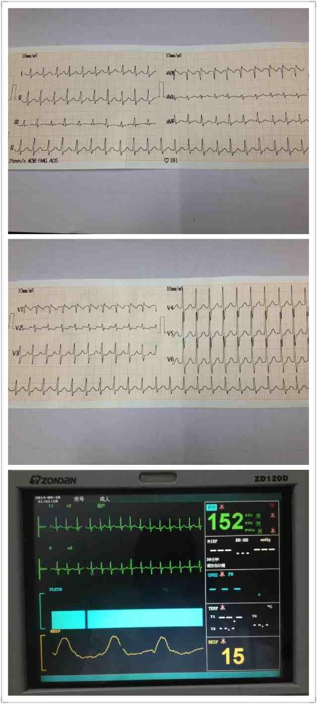 未见明显p波,考虑p-波与t波融合,诊断室上速  第二张图窦性心律,心电