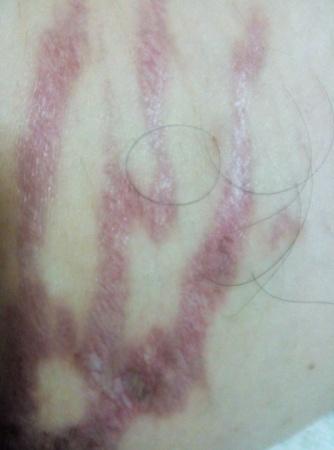 看图识病 - 皮肤及性传播疾病讨论版 - 爱爱医医学