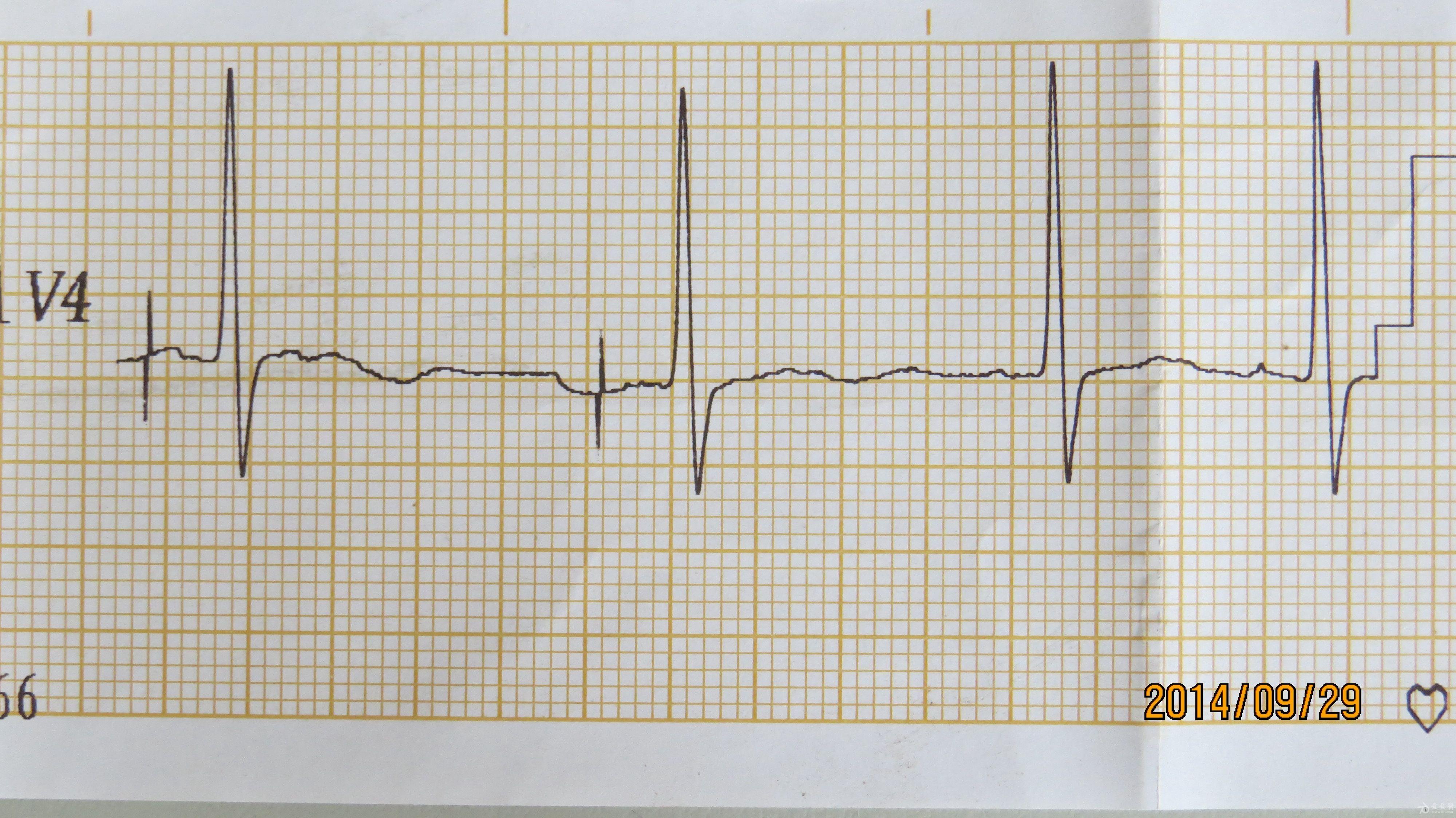 安装起搏器三年后的心电图
