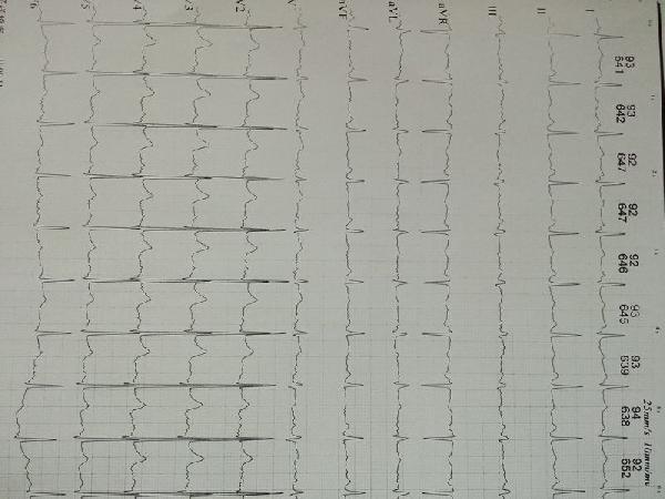 心电图 v2-v5导联出现qr 等位性q波?