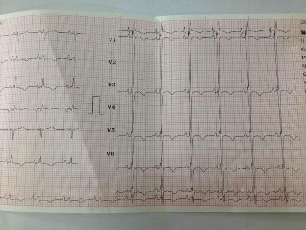 3楼回复trg5天前电轴右偏明显,p波高尖,v1导联呈现qr型,胸导联极度顺