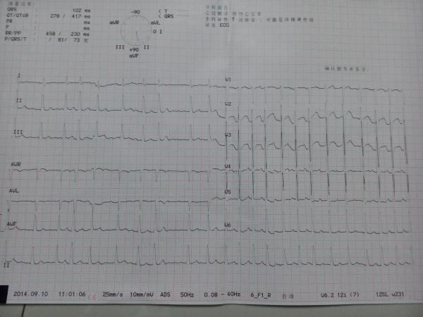 【踏雪识图】请大家分析心电图