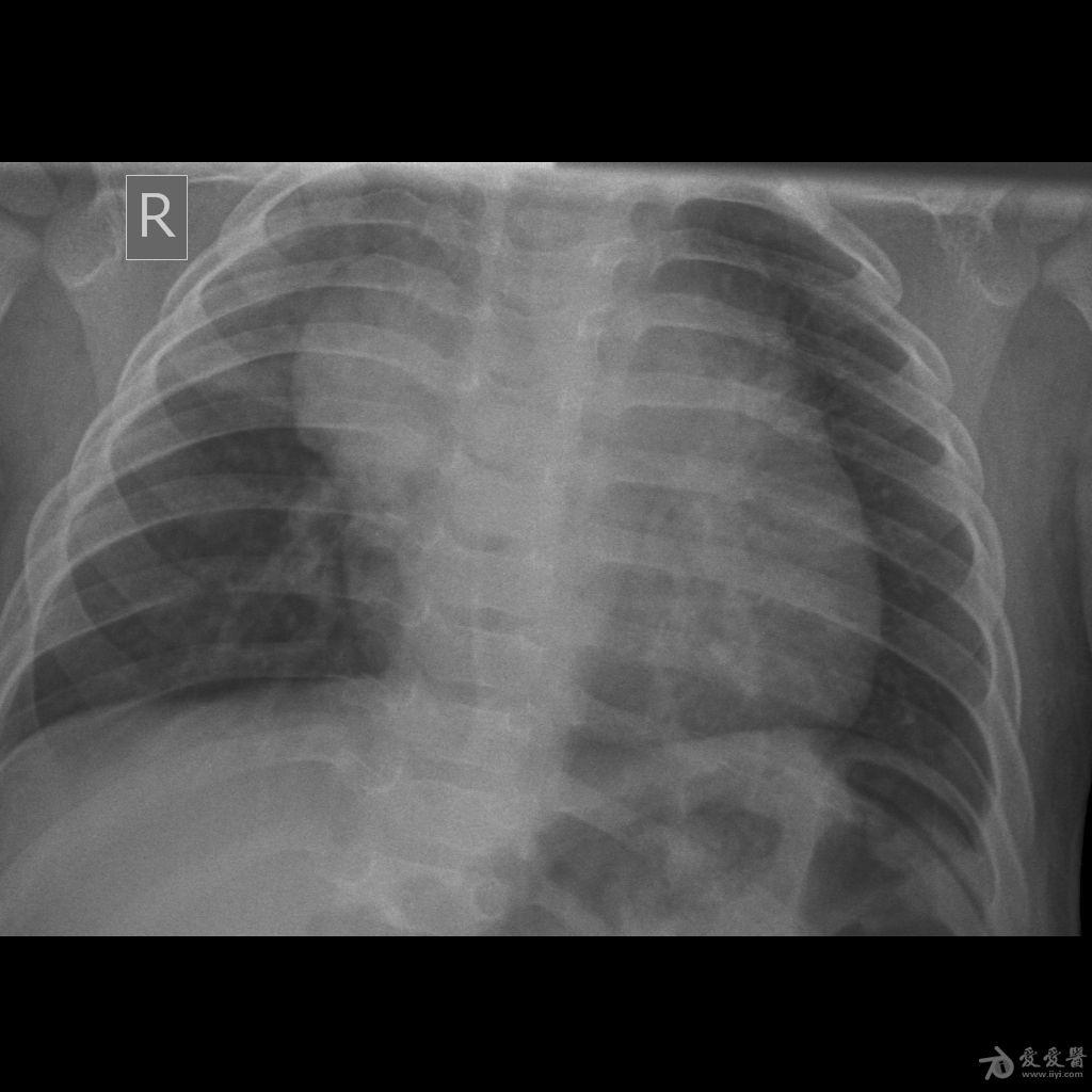 老师们,帮忙看看这张小儿胸片 谢谢