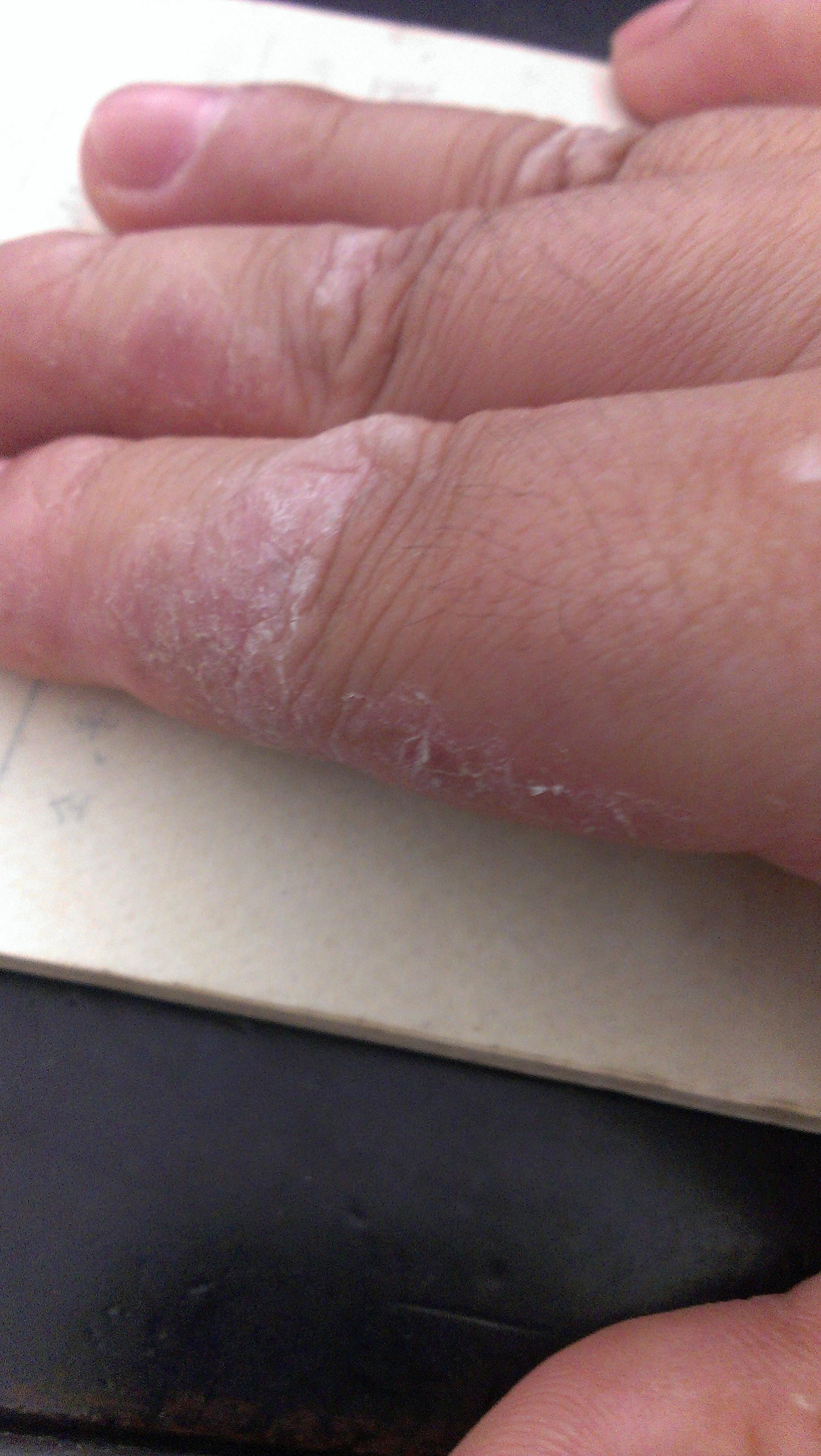 手癣湿疹 有好几年了,一到天热就开始褪皮痒痒,一到冬天就好了,也