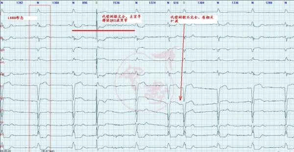 3楼回复trg6天前图中第一个提前的qrs波,代偿间歇完全,左室早搏使qrs