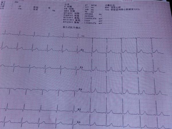 在平时心电图报告的诊断结果是否能下冠心病?