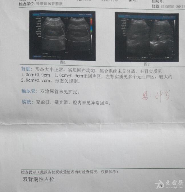 请问是什么类型的肾囊肿?(附b超图)