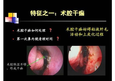 鼻内镜围手术期的处理.史剑波