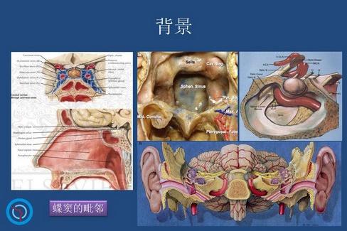 蝶窦的解剖学延伸.albert l.rhoton university of