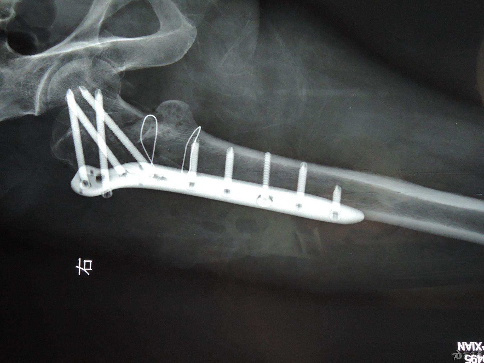 陈旧性股骨转子间骨折的手术方式选择