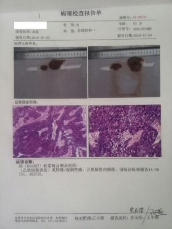 手术中病理切片,发现卵巢,乙状结肠,腹膜,大网膜,膀胱表面等发生转移
