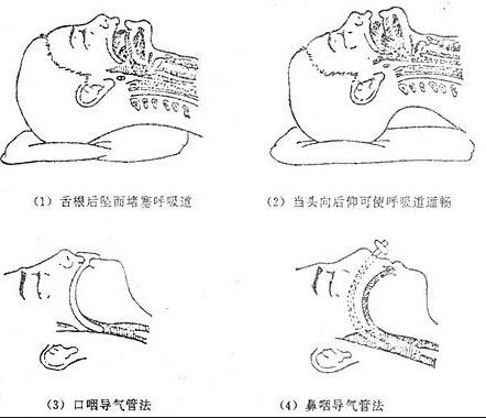 鼻咽通气管/口咽通气管----小小东西功劳大
