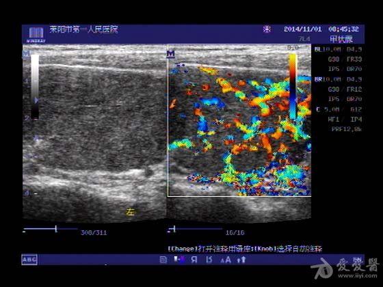 超声入门贴367-----桥本氏甲状腺炎伴甲亢