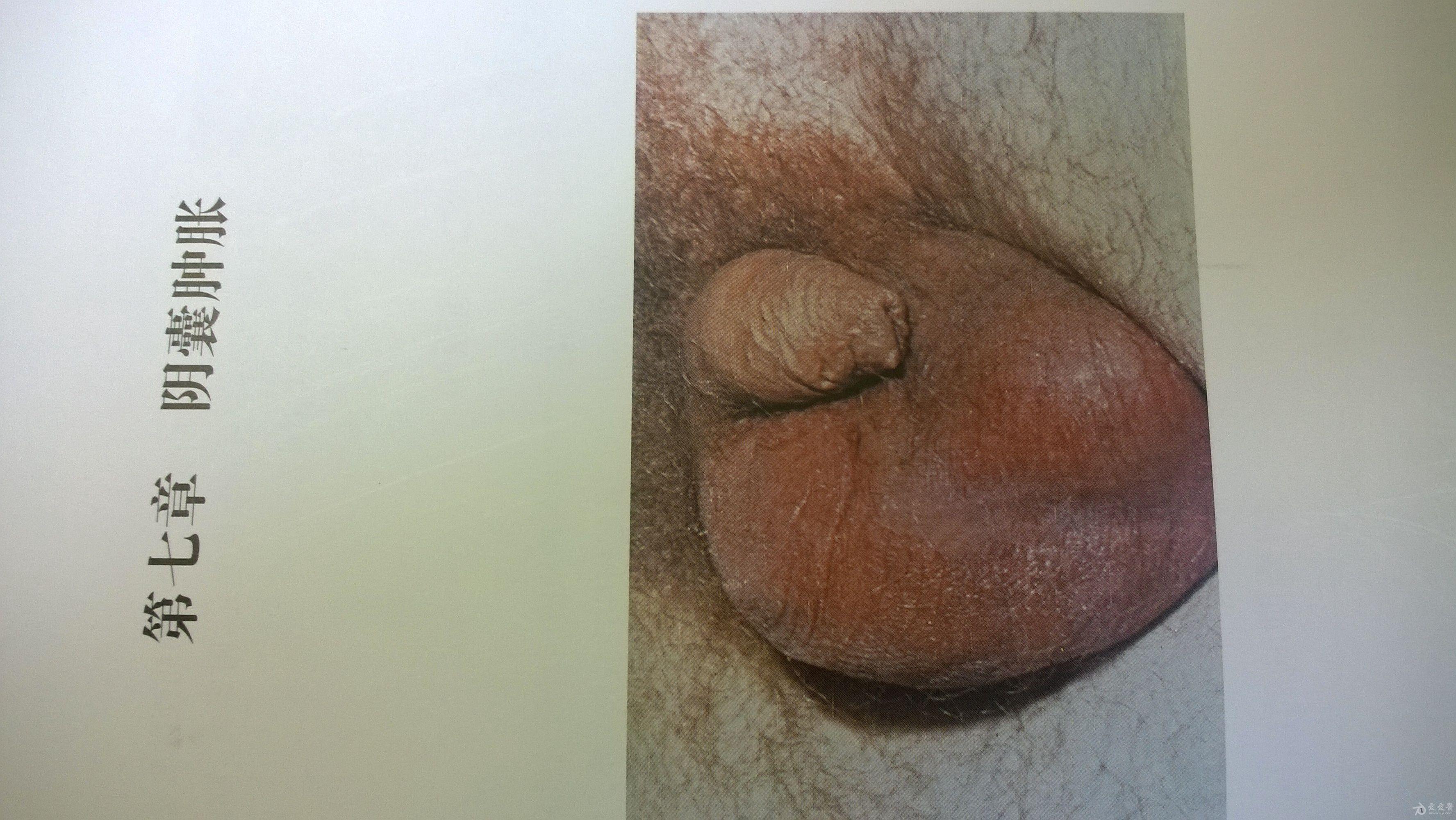 6,腹股沟横痃  7,新生儿眼炎    一,男性尿道分泌物     二,阴囊肿胀