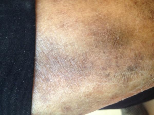 大家看看这是什么病 小腿下部色素沉重脱屑性湿疹
