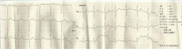 活动后气短的心电图