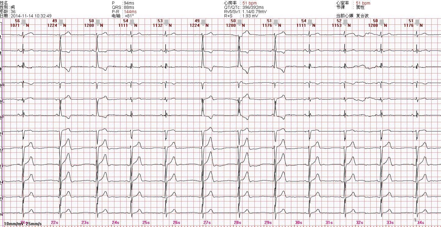 请教该图的心电图诊断