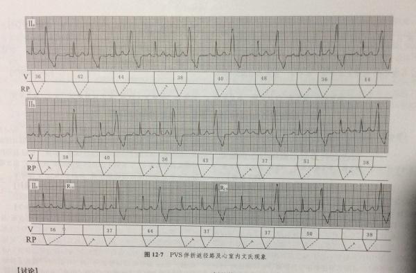 心电图 室性早搏的偶联间期不等,有室性融合波,为什么不是室性并行