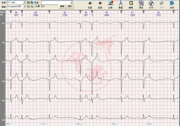 心电图学习20141117