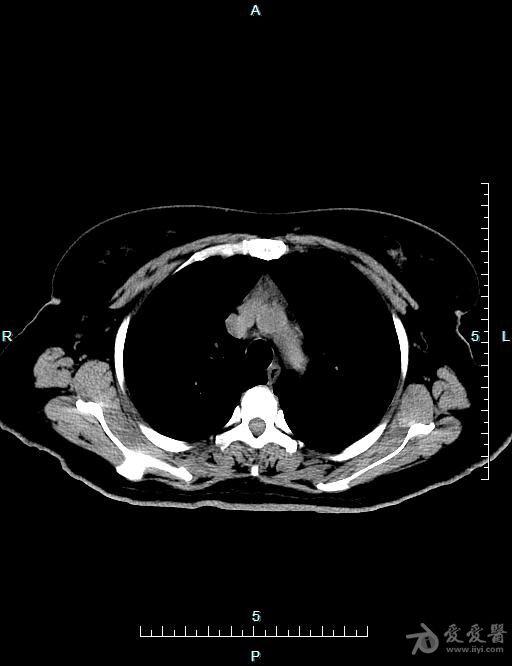 胸腺ct