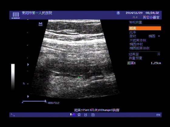 超声入门贴375---------急性化脓性阑尾炎(各式探头超声图比对)