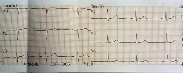 全科医生读心电图-最简单入门方法