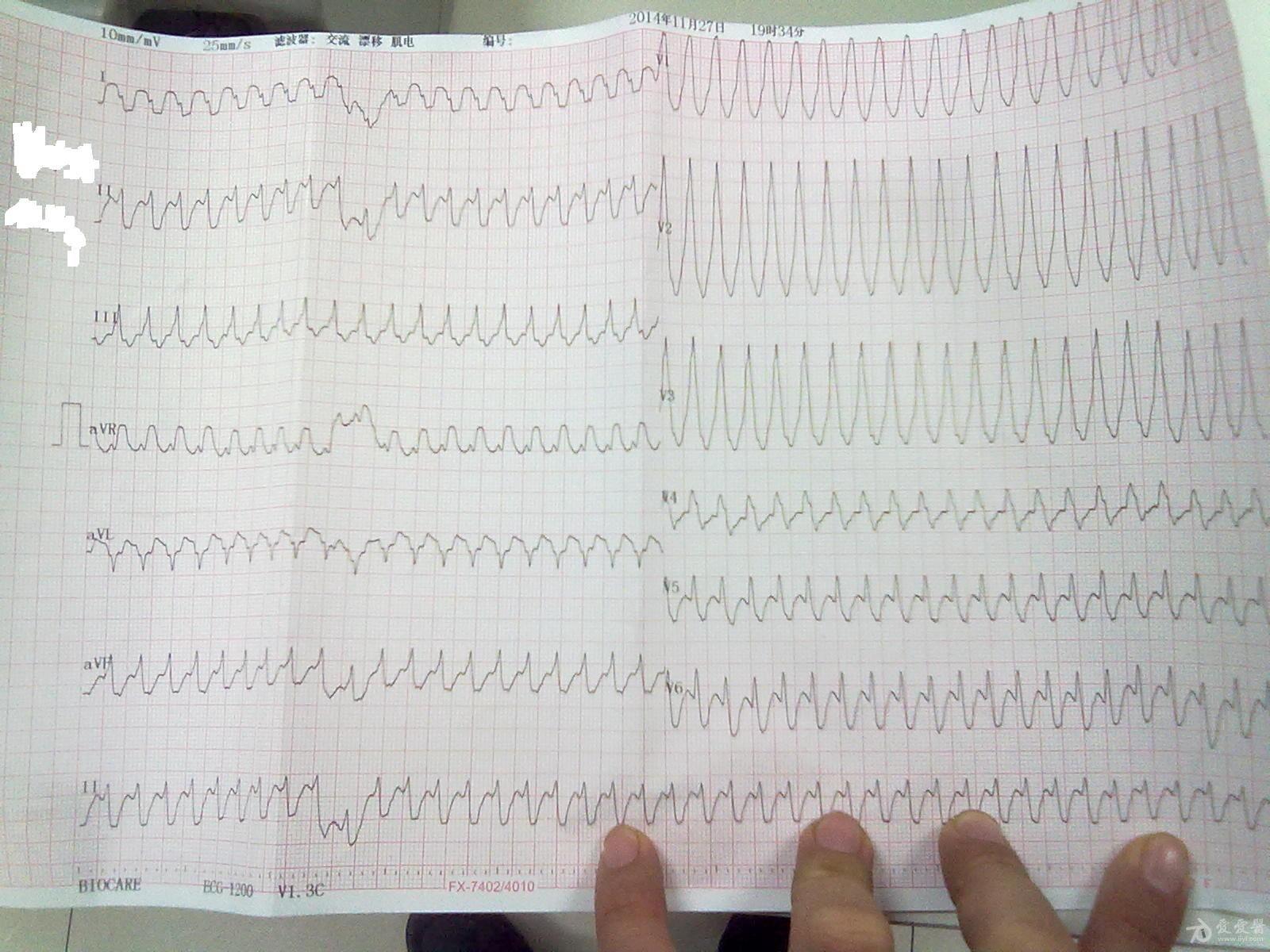 请教各位老师,这个心电图是室性心动过速吗?