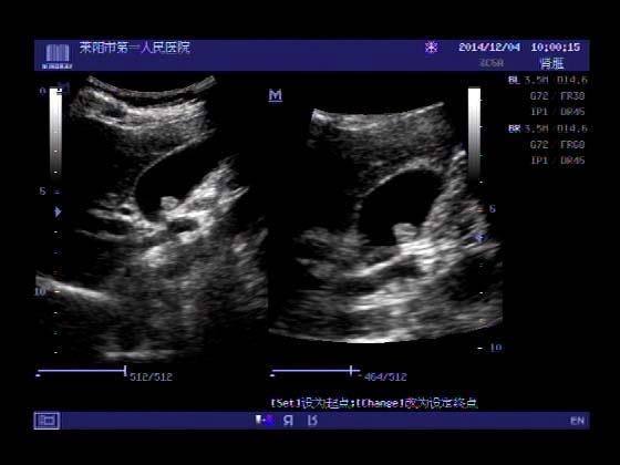 超声入门贴382--------容易误诊为胆囊息肉的病例