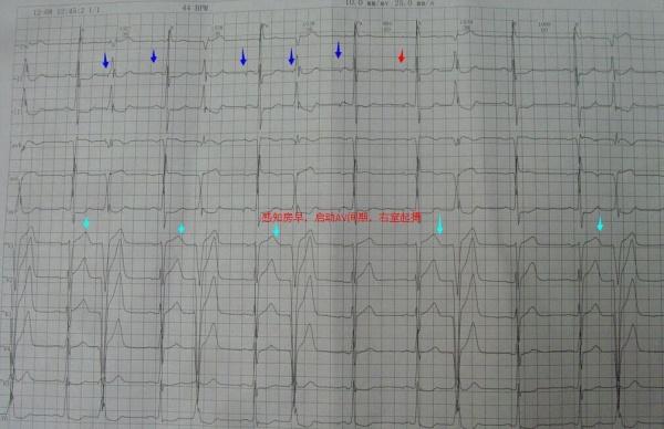 双腔起搏心电图