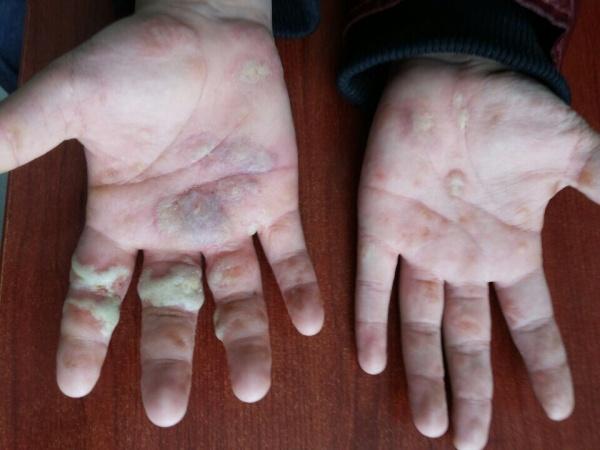 皮肤病有奖病例讨论10 ——掌趾脓疱病