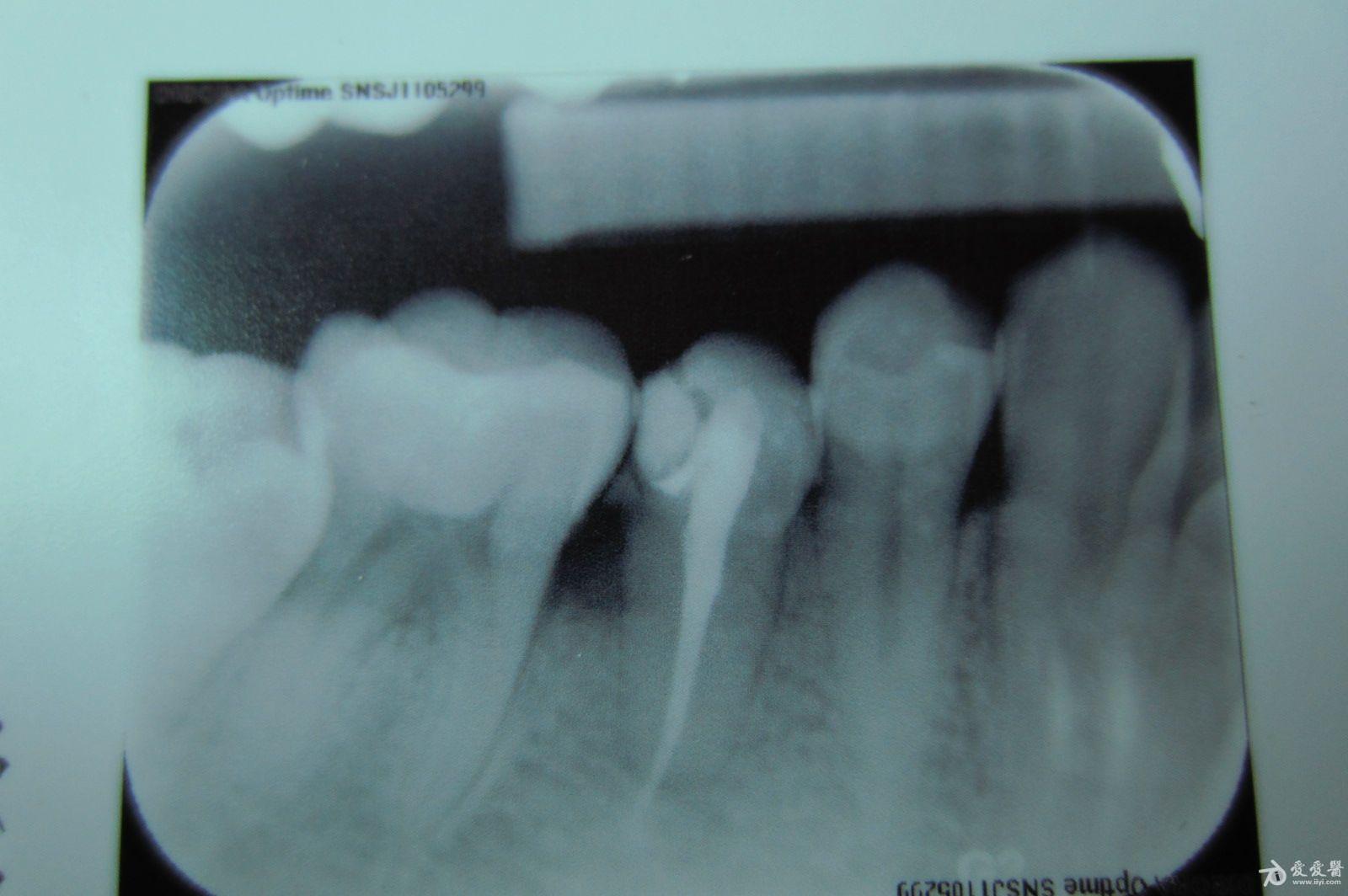 根管治疗后的牙片,,求诊断.