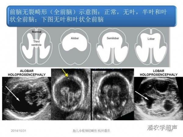 求助:30w 3d早生儿,b超结果为叶状全前脑,透明隔消失,前角相通,其它均