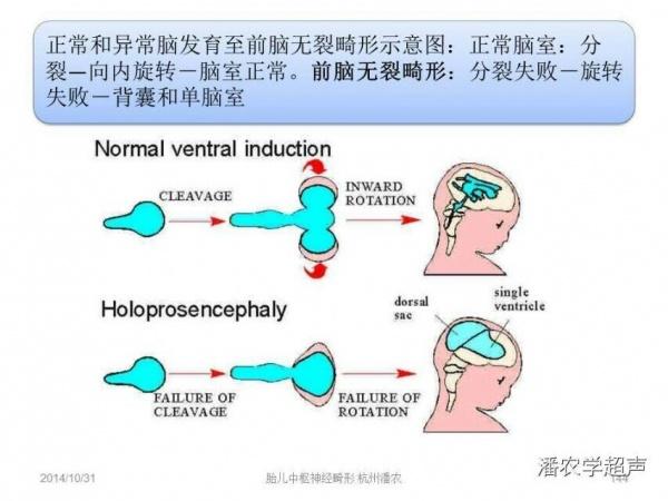 求助:30w 3d早生儿,b超结果为叶状全前脑,透明隔消失