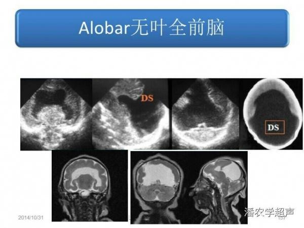 求助:30w 3d早生儿,b超结果为叶状全前脑,透明隔消失,前角相通,其它均