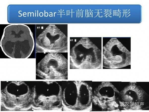 求助:30w 3d早生儿,b超结果为叶状全前脑,透明隔消失,前角相通,其它均