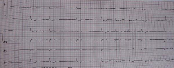 一例服地高辛1天1片(约4周)的病人心电图