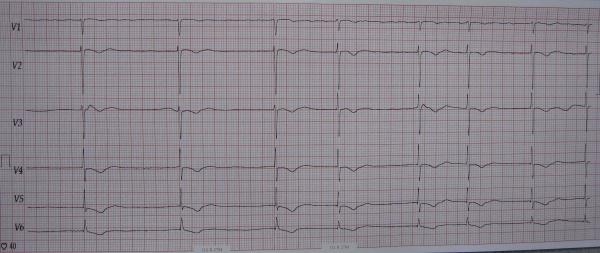一例服地高辛1天1片(约4周)的病人心电图