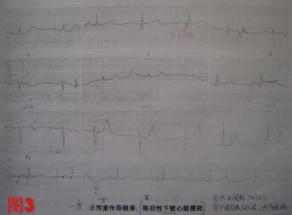 心梗按什么定位?是按红旗飘飘还是病理q波?             2.