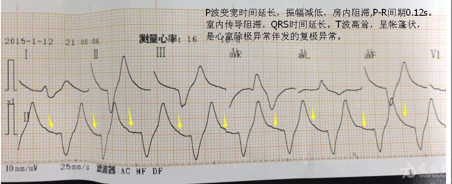 请教山羊老师,trg老师,比上不足老师们此份高钾血症的心电图如何出