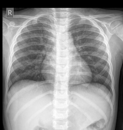 教学病例12——胸片阅读(支气管炎)