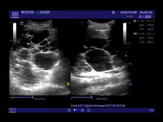 超声入门贴412-多囊肾