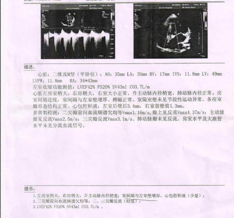复杂病例,仔细研读,这是心梗吗?这是1:1房扑吗